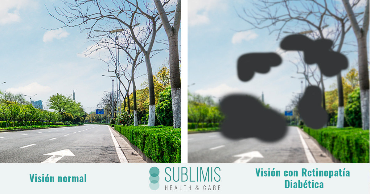 Retinopatía Diabética: qué es y cómo evitarla