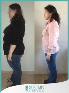 Antes y Despues de un Balon Gastrico