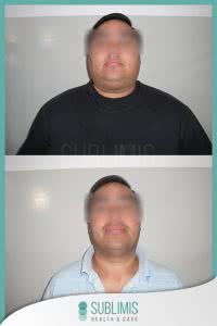 Antes y Después del Bypass Gastrico