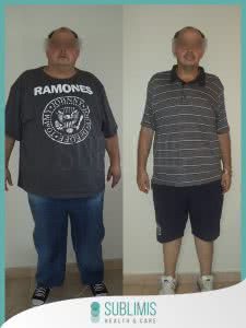 Hombre Antes y Despues de una Cirugia Bariatrica