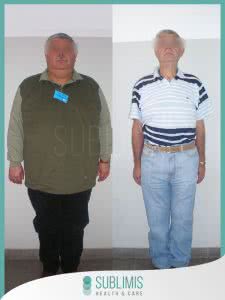 Antes y Después de una Cirugía Metabólica