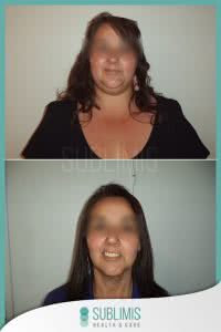 Antes y Despues del Cruce Duodenal