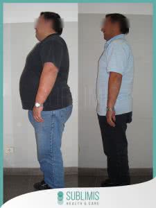 Antes y Despues de una Operacion de Bypass Gastrico