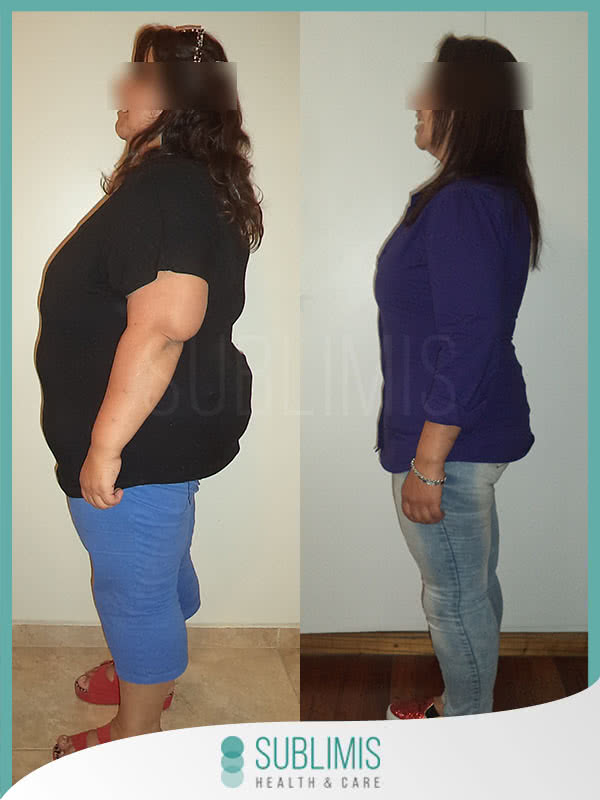 Fotos de una mujer antes y después de una operación para perder peso