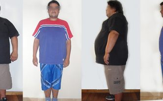 Antes y Después de un Bypass Gastrico