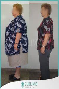 Bypass Gastrico Antes y Despues