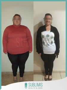 Bypass Gastrico Mujer Antes y Despues