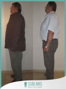 Cirugia Obesidad Antes y Despues