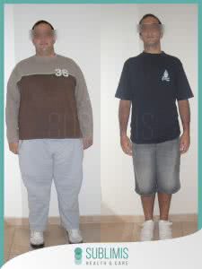 Fotos Antes y Despues de Cirugia Bariatrica