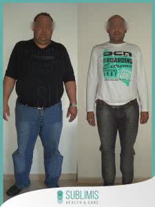 Operación Bypass Gástrico Antes y Después