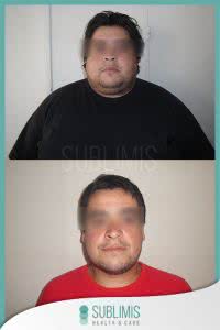 Resultados Cirugia de Bypass Gastrico