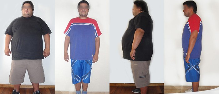 Antes y Después de un Bypass Gastrico