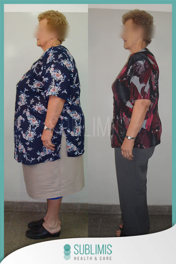 Bypass Gastrico Antes y Despues