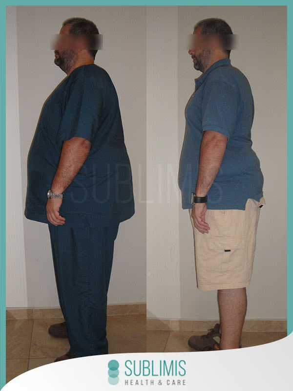 Cruce Duodenal
