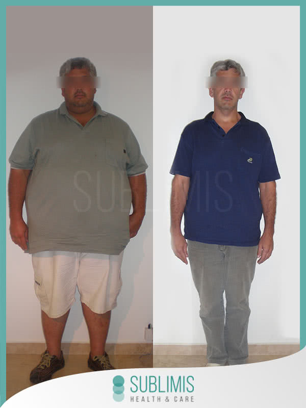 Fotos de Antes y Después Operación de Banda Gástrica