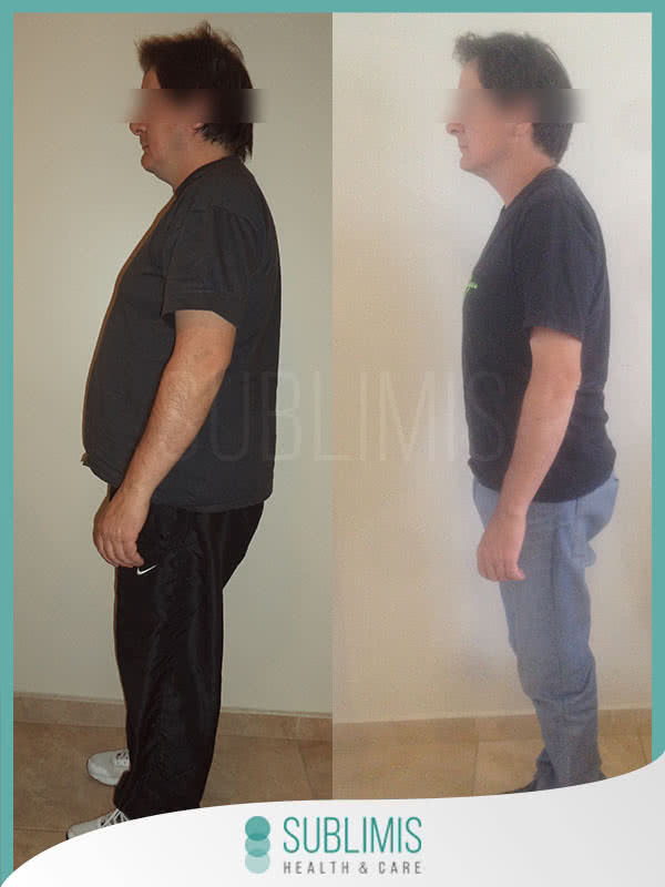 Operación Banda Gástrica Antes y Después