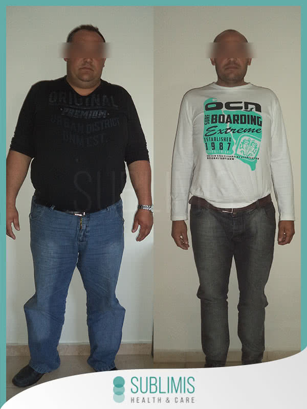 Operación Bypass Gástrico Antes y Después