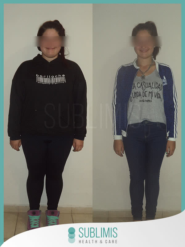 Resultados Cirugia Bariatrica en Chicas