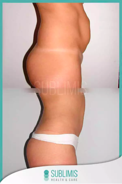 Beneficios de la abdominoplastia