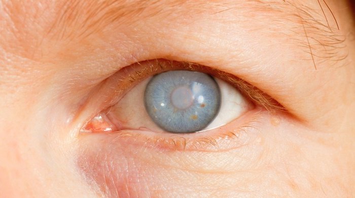 Presión ocular por el glaucoma