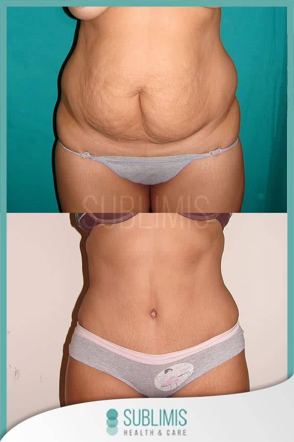 Cirugía de abdomen, antes y después